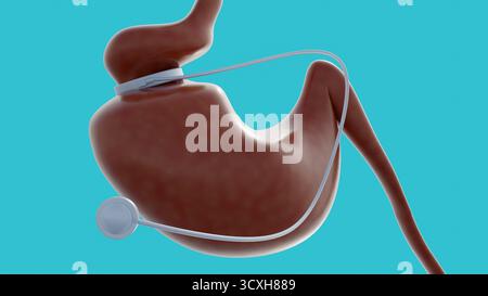 Ein 3D-Bild des Magenbandes ist ein einstellbares, aufblasbares Silikongerät, das in einer Art bariatrischer Chirurgie (Gewichtsverlust-Chirurgie) verwendet wird. Stockfoto