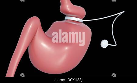 Ein 3D-Bild des Magenbandes ist ein einstellbares, aufblasbares Silikongerät, das in einer Art bariatrischer Chirurgie (Gewichtsverlust-Chirurgie) verwendet wird. Stockfoto