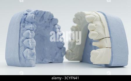 Nahaufnahme von Ober- und Unterkieferformen, die in der Zahnheilkunde zur kieferorthopädischen Planung, Zahnprothetik oder zur Analyse der Kieferausrichtung verwendet werden. Stockfoto