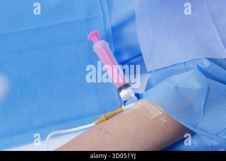 Nahaufnahme einer Spritze an einer IV-Kanüle an einem drapierten Patientenarm zur Anästhesie und Medikamentenverabreichung in einer modernen Klinik Stockfoto