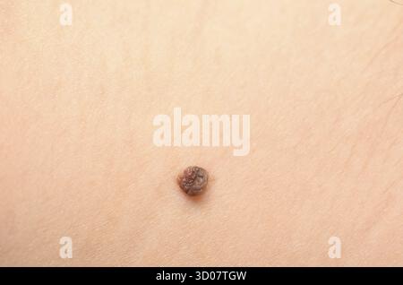 Nahaufnahme des Maulwurfs auf der menschlichen Haut Stockfoto