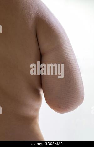 Der Oberkörper der Person zeigt einen amputierten Arm mit strukturierter Restgliedmasse, wobei Themen wie Behinderung, Gesundheit und Anpassung hervorgehoben werden Stockfoto