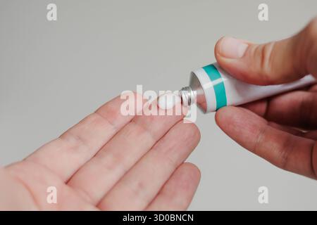Nahaufnahme eines Mannes, der Salbe aus der Röhre an seinem Finger drückt Stockfoto
