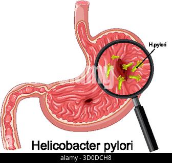 Vektorquerschnitt des Magens mit vergrößerten Helicobacter pylori-Bakterien, klare Markierung, helle Farben Stock Vektor