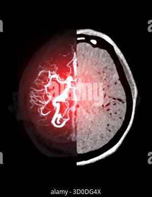 Eine zweiperspektivische Ansicht des Gehirns, die die Blutgefäße auf der einen Seite in leuchtendem Rot und auf der anderen Seite einen Graustufen-CT-Scan zeigt, der die blende symbolisiert Stockfoto