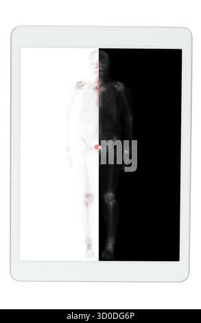 Eine Ganzkörper-Knochenuntersuchung auf der Tablette wurde nach intravenöser Injektion von TC-99m MDP durchgeführt. Stockfoto