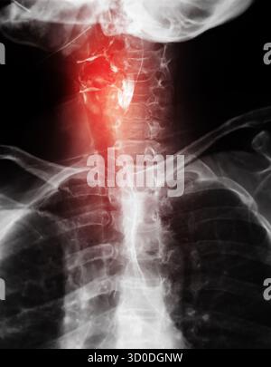 Röntgenbild der oberen Speiseröhre mit normaler Schluckfunktion ohne Anzeichen von Obstruktion oder Anomalie im Rachenbereich. Stockfoto
