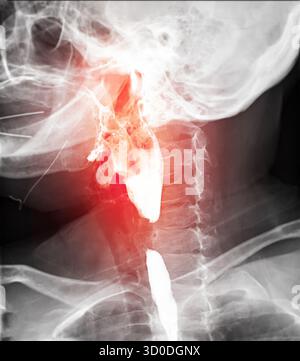 Röntgenbild der oberen Speiseröhre mit normaler Schluckfunktion ohne Anzeichen von Obstruktion oder Anomalie im Rachenbereich. Stockfoto