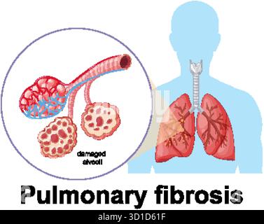 Vektordiagramm, das beschädigte Alveolen in der Lunge zeigt und die Lungenfibrose mit markierter Anatomie hervorhebt Stock Vektor