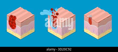 3D Isometrische flache Illustration der Hautreinigung, Dermatologie, Hautpflege und Anti-Aging 3D Isometrische flache Illustration der Haut C Stockfoto