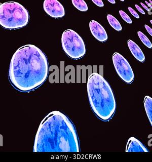 Farbige Computertomographie (CT)-Scans des Gehirns eines Patienten, der einen Schlaganfall erlitten hat. Der Schlaganfall oder zerebrovaskulärer Unfall (CVA) wurde durch eine Blutung in den linken Basalganglien verursacht. Stockfoto