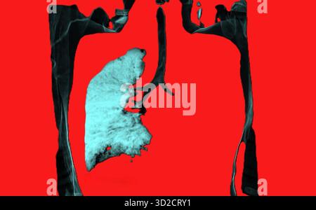 Farbige Computertomographie (CT) eines Patienten mit linker Lunge ohne Luft aufgrund eines Karzinoms. Stockfoto