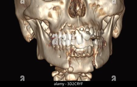 Farbige 3D-Computertomographie (CT) eines frakturierten Unterkiefers (Unterkiefer). Stockfoto