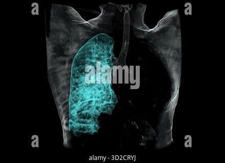 Farbige 3D-Computertomographie (CT) eines Patienten mit linker Lunge ohne Luft aufgrund eines Karzinoms. Stockfoto