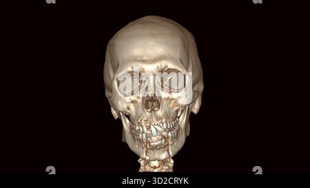 Farbige 3D-Computertomographie (CT) eines frakturierten Unterkiefers (Unterkiefer). Stockfoto