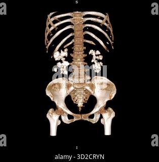 Farbige 3D-Computertomographie (CT) eines Patienten mit beidseitigen Nierensteinen (weiß). Stockfoto