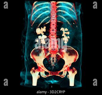 Farbige 3D-Computertomographie (CT) eines Patienten mit beidseitigen Nierensteinen (weiß). Stockfoto