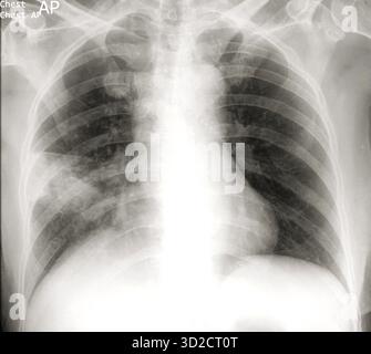 Röntgenaufnahme des Thorax eines Patienten mit Pneumonie. Pneumonie wird am häufigsten durch das Bakterium Streptococcus pneumoniae verursacht. Der Erreger wird in ein Lungensegment oder Lappen eingeatmet, wo er eine Blockierung der Alveolen (Luftsäcke) mit Eiter bewirkt. Symptome sind Fieber und Schüttelfrost, Husten mit rostigem oder eiterähnlichem Sputum und Brustschmerzen. Die Behandlung erfolgt mit Antibiotika. Stockfoto