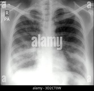 Röntgenaufnahme des Thorax eines Patienten mit Pneumonie. Pneumonie wird am häufigsten durch das Bakterium Streptococcus pneumoniae verursacht. Der Erreger wird in ein Lungensegment oder Lappen eingeatmet, wo er eine Blockierung der Alveolen (Luftsäcke) mit Eiter bewirkt. Symptome sind Fieber und Schüttelfrost, Husten mit rostigem oder eiterähnlichem Sputum und Brustschmerzen. Die Behandlung erfolgt mit Antibiotika. Stockfoto