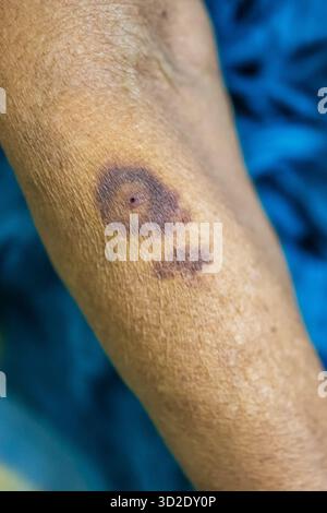 Altersbedingte Hautverfärbung am Arm mit Hämatom oder Purpura Stockfoto