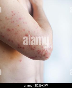 Weit verbreitete rote juckende Flecken auf einer bemannten Haut mit Trockenheit und Schuppung, die ein Aufflammen des chronischen Ekzems im Video zeigen. Stockfoto