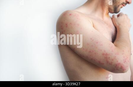 Kleine Bläschen und rote juckende Flecken bedecken einen menschlichen Körper, der typische Symptome der erwachsenen Windpocken im Video zeigt. Stockfoto