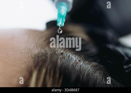 Nahaufnahme auf Frau Kopf erhalten Mesotherapie Injektionen für stärkeres und gesünderes Haar. Hochwertige Fotos Stockfoto