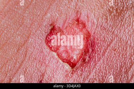 Nahaufnahme eines Basalzellkarzinoms auf der Gesichtshaut mit ulzerierter, unregelmäßiger Läsion mit Krustenbildung und Gewebeabbau, die auf eine gemeinsame Haut Ca hindeuten Stockfoto