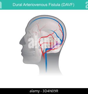Durale arteriovenöse Fistel (DAVF). Es zeigt einen Querschnitt eines menschlichen Kopfes, mit sichtbarem Schädel und Gehirn. Stock Vektor