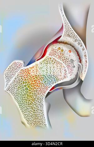 Hüftarthrose (Hüftkopf und Acetabulum). Der Knorpel am Oberschenkelkopf und Acetabulum ist abgetragen, Osteophyten (knöcherne Wucherungen) haben sich gebildet. Stockfoto