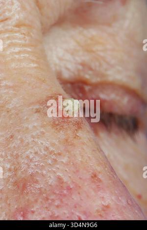 Invasives Plattenepithelkarzinom der Nase, das sich auf aktinischer Keratose bei einer 77-jährigen Frau entwickelt. Stockfoto