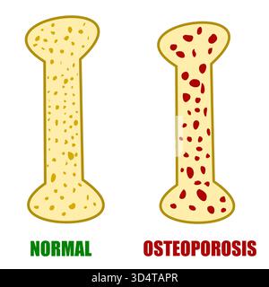 Vergleich von normalem Hea;your bone versus bone mit osteoporosemedizinischer illustraion-Krankheit Stock Vektor