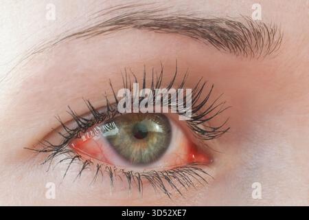 Gerötete, irritierte menschliche Augen in Nahaufnahme, Allergiesymptom Stockfoto