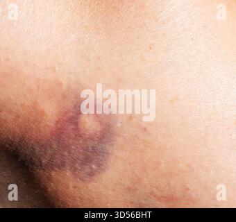 Nahaufnahme von blaue Flecken auf der Haut Stockfoto