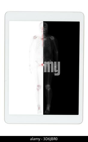 Eine Ganzkörper-Knochenuntersuchung auf der Tablette wurde nach intravenöser Injektion von TC-99m MDP durchgeführt. Stockfoto