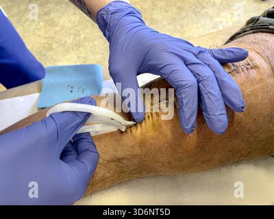 Klinische Entfernung chirurgischer Klammern aus einem heilenden Knieschnitt bei postoperativer Versorgung nach Knietotalersatz: Phillip Roberts Stockfoto