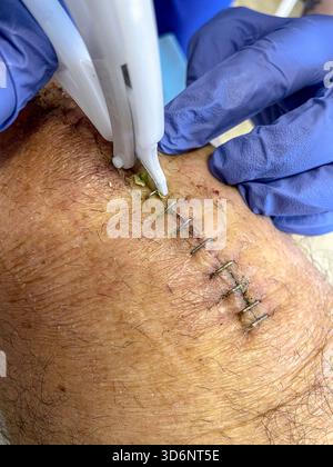 Klinische Entfernung chirurgischer Klammern aus einem heilenden Knieschnitt bei postoperativer Versorgung nach Knietotalersatz: Phillip Roberts Stockfoto