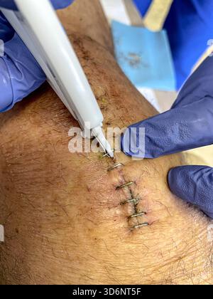 Klinische Entfernung chirurgischer Klammern aus einem heilenden Knieschnitt bei postoperativer Versorgung nach Knietotalersatz: Phillip Roberts Stockfoto