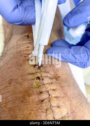 Klinische Entfernung chirurgischer Klammern aus einem heilenden Knieschnitt bei postoperativer Versorgung nach Knietotalersatz: Phillip Roberts Stockfoto