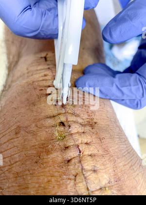 Klinische Entfernung chirurgischer Klammern aus einem heilenden Knieschnitt bei postoperativer Versorgung nach Knietotalersatz: Phillip Roberts Stockfoto