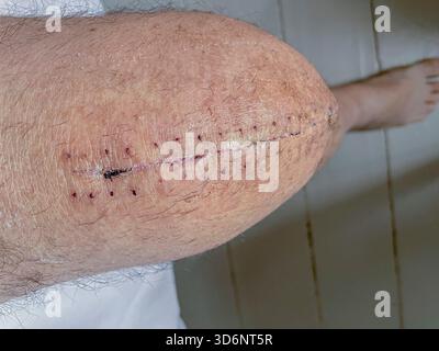 Klinische Entfernung chirurgischer Klammern aus einem heilenden Knieschnitt bei postoperativer Versorgung nach Knietotalersatz: Phillip Roberts Stockfoto
