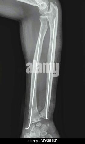 Röntgenaufnahme des Unterarms mit gebrochenem Radius und innerlich fixierten Ulnaknochen. Die Fixierung stabilisiert den Knochen, um die Ausrichtung beizubehalten und eine korrekte Heilung zu fördern. Diese Operation ist in schweren Fällen erforderlich, in denen sich die Knochen aus ihrer Position bewegt haben. Stockfoto