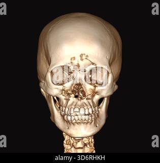 Farbige 3D-Computertomographie (CT) des Kopfes eines Patienten mit Schädelfraktur. Es gibt eine Fraktur im Stirnbein und in der Kieferhöhlenwand. Stockfoto