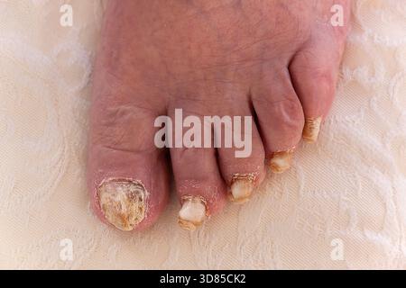 Nagelpilzinfektion (Chychomykose), die verfärbte, dicke und brüchige Nägel verursacht. Dies ist ein schwerwiegender Fall. Stockfoto