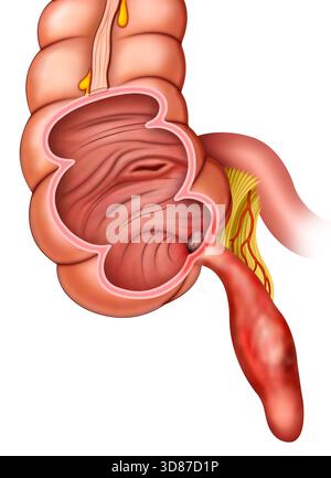 Illustration der Entzündung des Blinddarms. Appendizitis ist eine Entzündung eines beutelartigen Organs, das mit dem Dickdarm verbunden ist. Symptome sind Bauchschmerzen, Übelkeit und Fieber. Die Erkrankung kann sich ernsthaft entwickeln, wenn der entzündete Blinddarm platzt und Bakterien in den Bauch freigesetzt werden. Stockfoto
