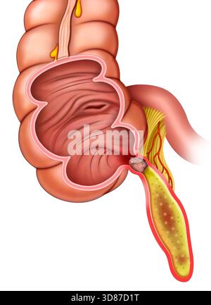 Abbildung zur Flüssigkeitsansammlung bei Appendizitis. Flüssigkeitsansammlung um den entzündeten Blinddarm, ein Appendikolith genannt, blockiert den Blinddarm, wodurch sich Sekrete im Inneren ansammeln, Druck und Entzündung erhöhen. Wenn die Blinddarmentzündung unbehandelt bleibt, kann diese Ansammlung von Eiter zu einer Blinddarmperforation führen. Stockfoto