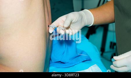 Ein Anästhesiologe verabreicht einem Patienten mit einer speziellen Nadel eine Spinalanästhesie. Eine Nahaufnahme der Hände des Anästhesisten, mit sterilen Handschuhen, mit einer Epiduralanästhesiennadel. Stockfoto