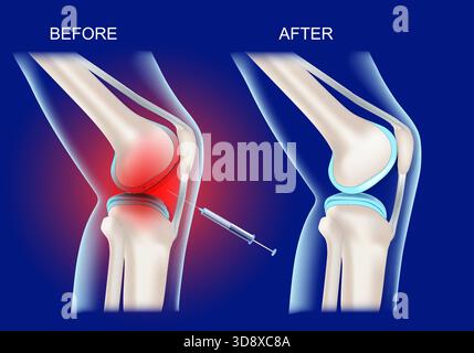 Knieschmerzbehandlung. Vor und nach der Therapie. Die menschliche Kniegelenkentzündung. Realistisches menschliches Knie auf blauem Hintergrund. Vektorabbildung Stock Vektor
