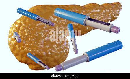 Ein 3D-Rendering der menschlichen Bauchspeicheldrüse und mehrerer blauer und violetter Autoinjektor-Pens, die häufig für die Insulinverabreichung bei Menschen mit Diabetes verwendet werden. Stockfoto