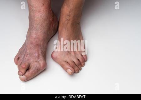 Füße einer älteren Frau mit sichtbarer Wirkung von Bunion und Hallux valgus, mit Deformität des MTP-Gelenks, das Grosszehe mit Fuß verbindet. Gemeinkosten-Nahaufnahme der Bedingung Stockfoto